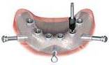 Perfect Smile clinical steps for Nobel Guide